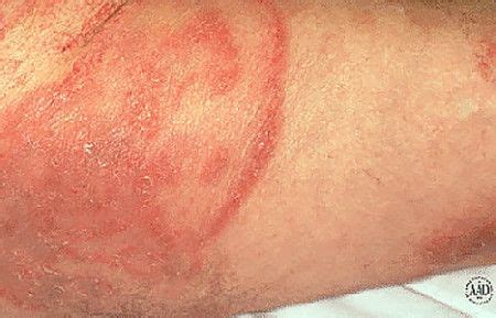 Eczema on buttcrack <s> Cancer</s>